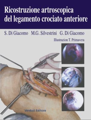 Ricostruzione Artroscopica del Legamento Crociato Anteriore