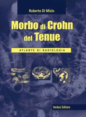 Morbo di Crohn del Tenue